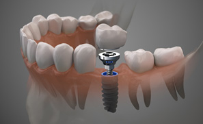 Example of a dental implant in Federal Way