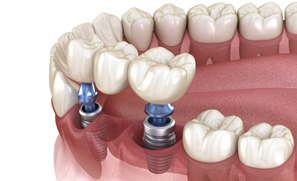 Example of an implant bridge in Federal Way