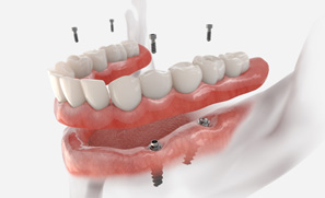 Example of an implant denture in Federal Way